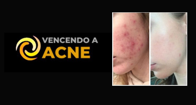 Acne e Hormônios: Soluções para uma Pele Saudável e Livre de Acnes