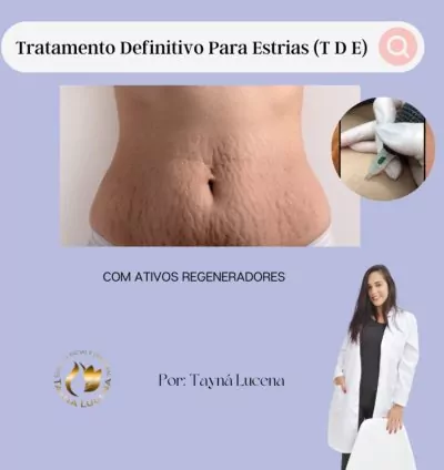 Tratamento Definitivo Para Estrias